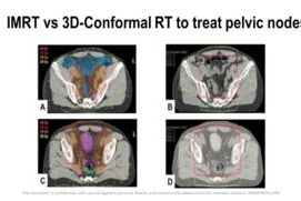 IMRT vs RT 3D Conformada para tratar los ganglios pélvicos en cáncer de próstata