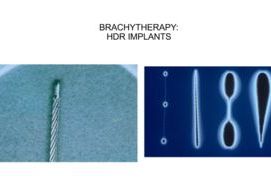 Braquiterapia de próstata: implantes hdr