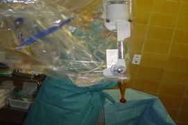 El Instituto IMOR realiza el primer tratamiento de cáncer de mama con radioterapia intraoperatoria en la Península