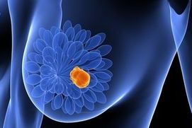 Células inmunitarias favorecen la progresión del cáncer de mama